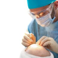 hair transplant