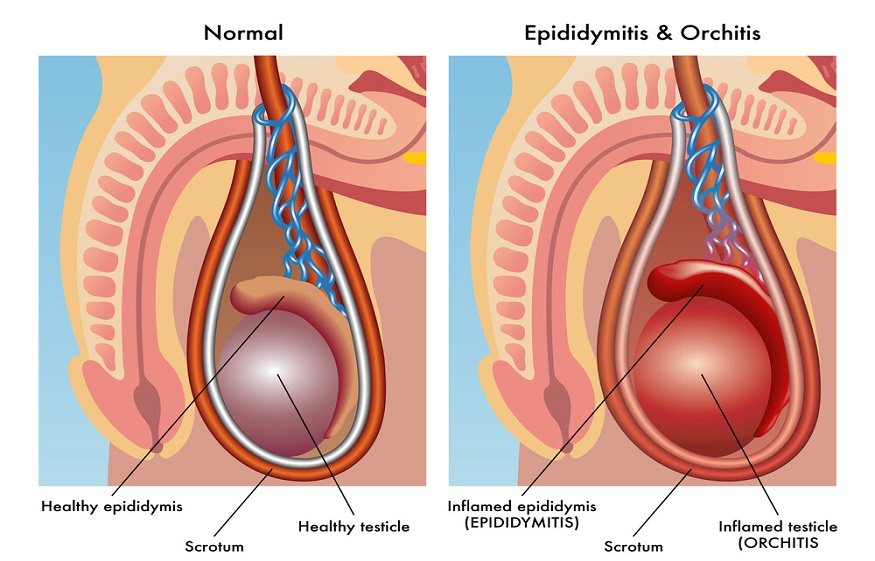 What Is Epididymitis? Discuss It’s Symptoms, Causes And Treatment