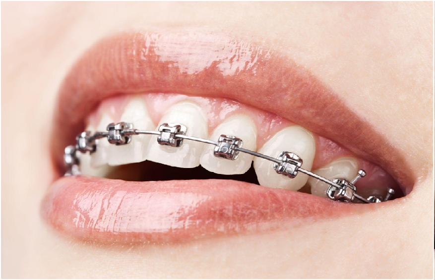 Invisalign Or Braces: Which Option Is The Best?