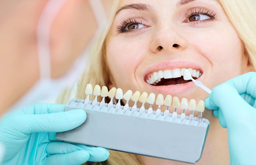 Everything You Need to Know About Dental Veneers