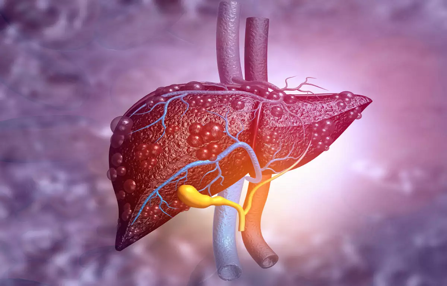 Liver Cirrhosis: The Slow Killer – How to Detect and Prevent the Progression!
