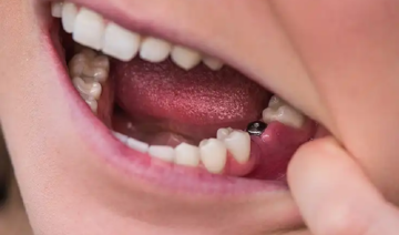 dental implants melbourne