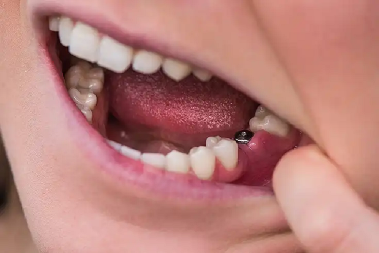 dental implants melbourne